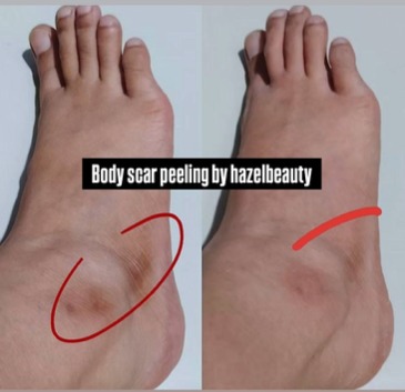 Body Treatment