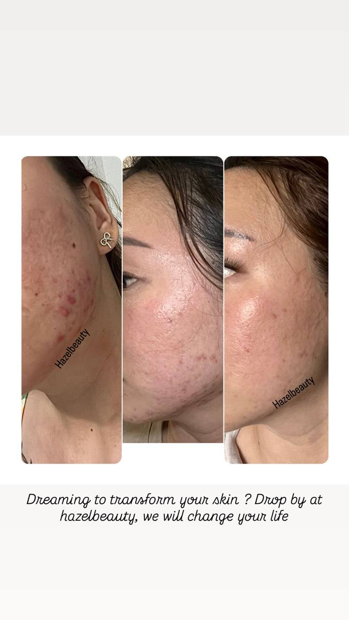 Skin Booster Treatment