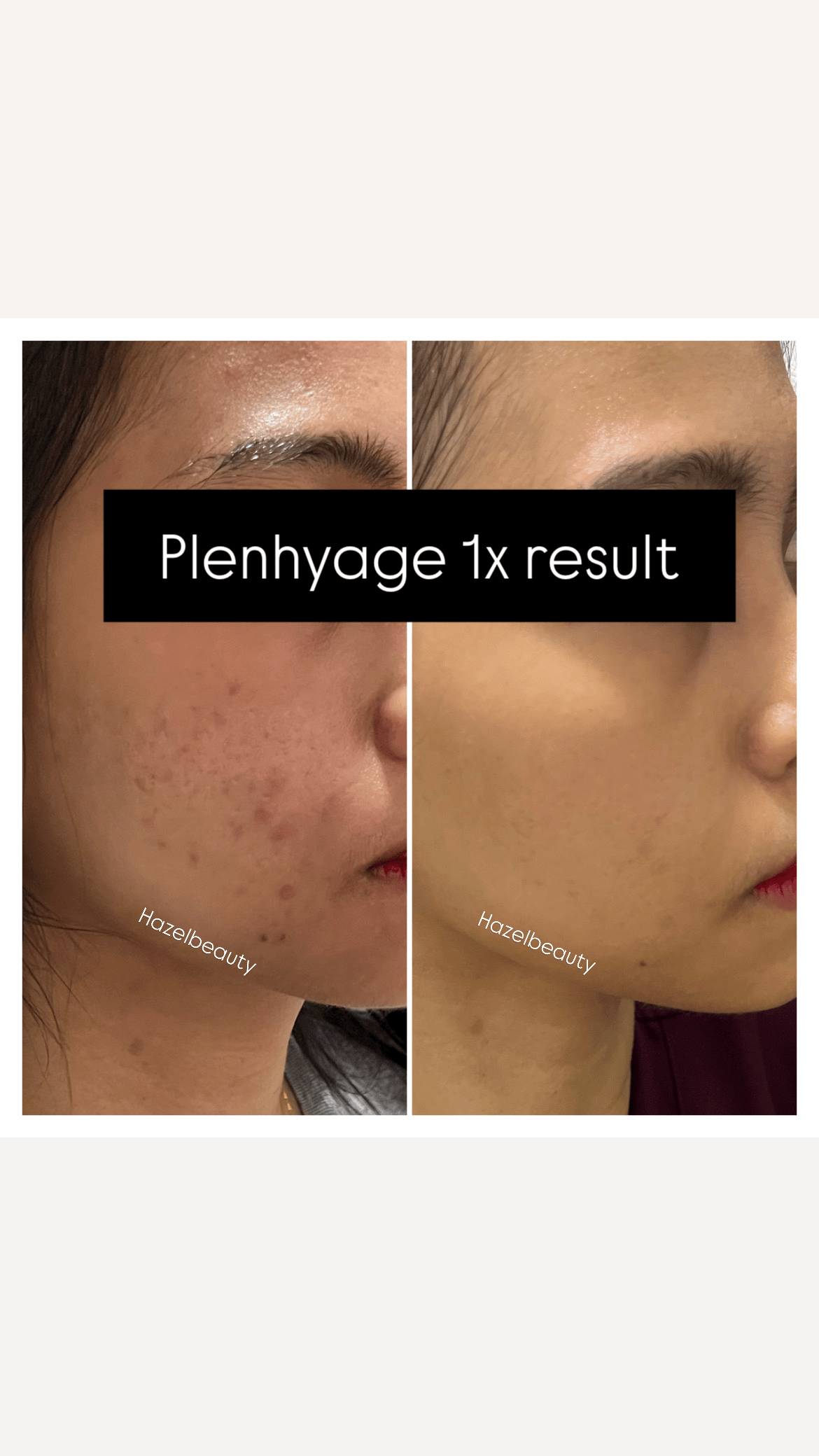 Face Treatment Before & After