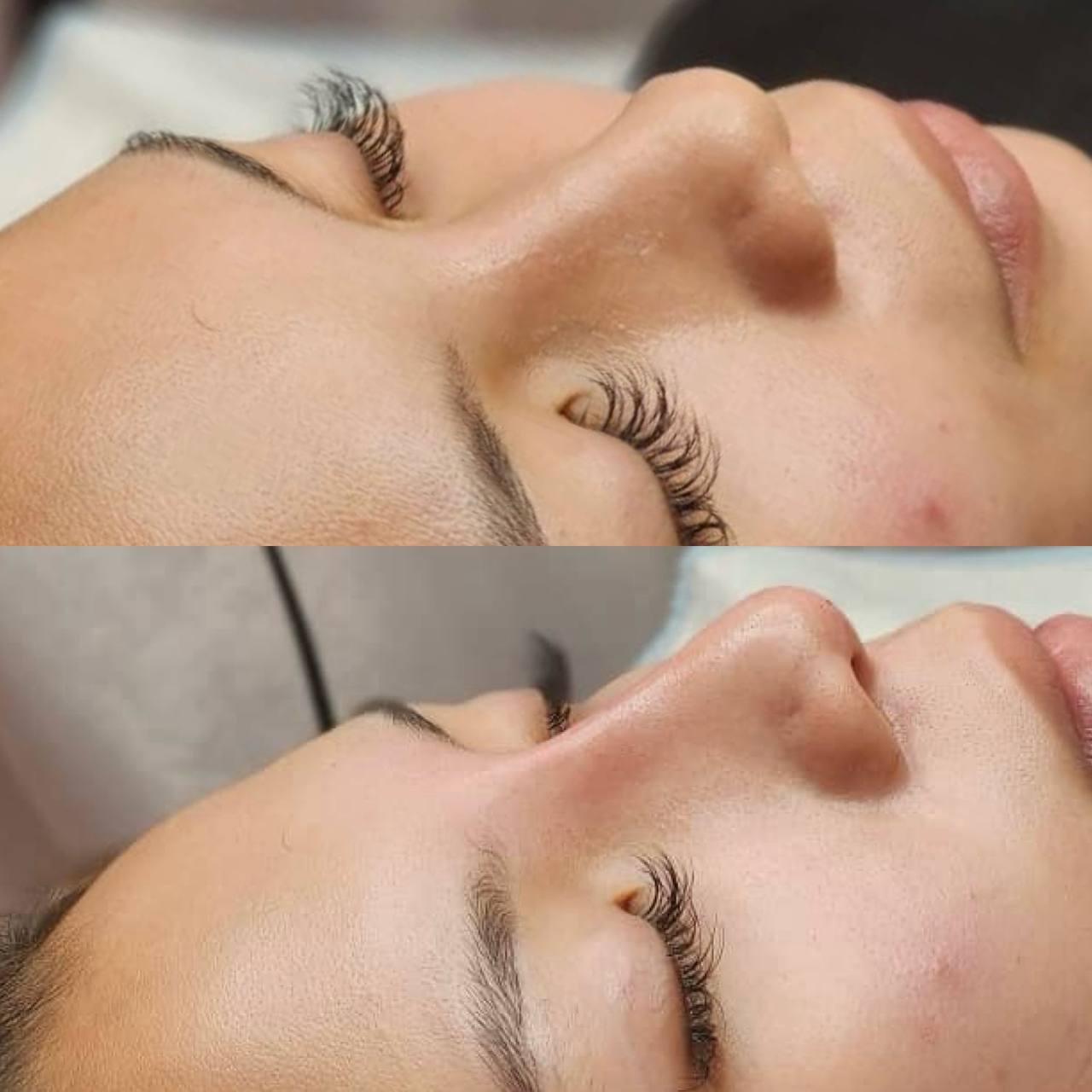 Threadlift, Fillers & Botox