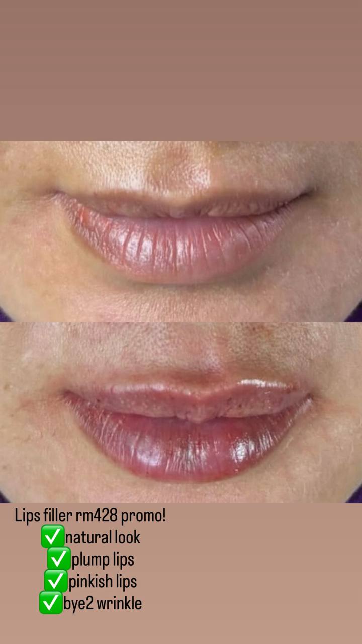 Threadlift, Fillers & Botox