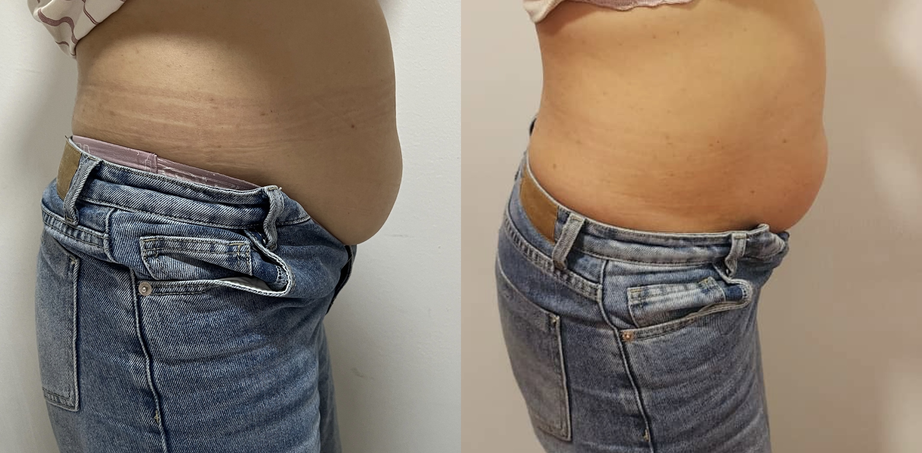 slimming / Lymphatic Massage