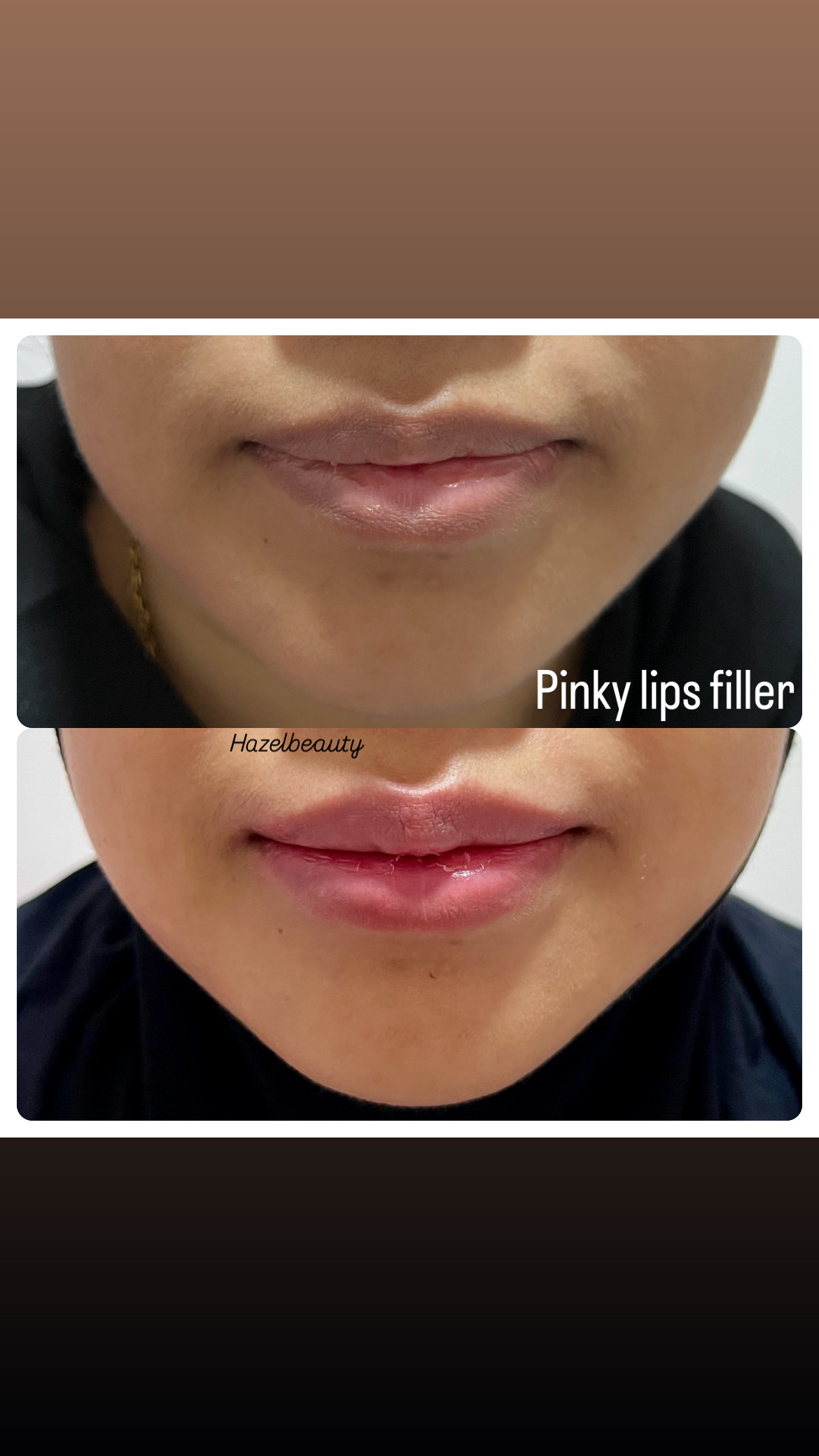Botox & Fillers Treatment