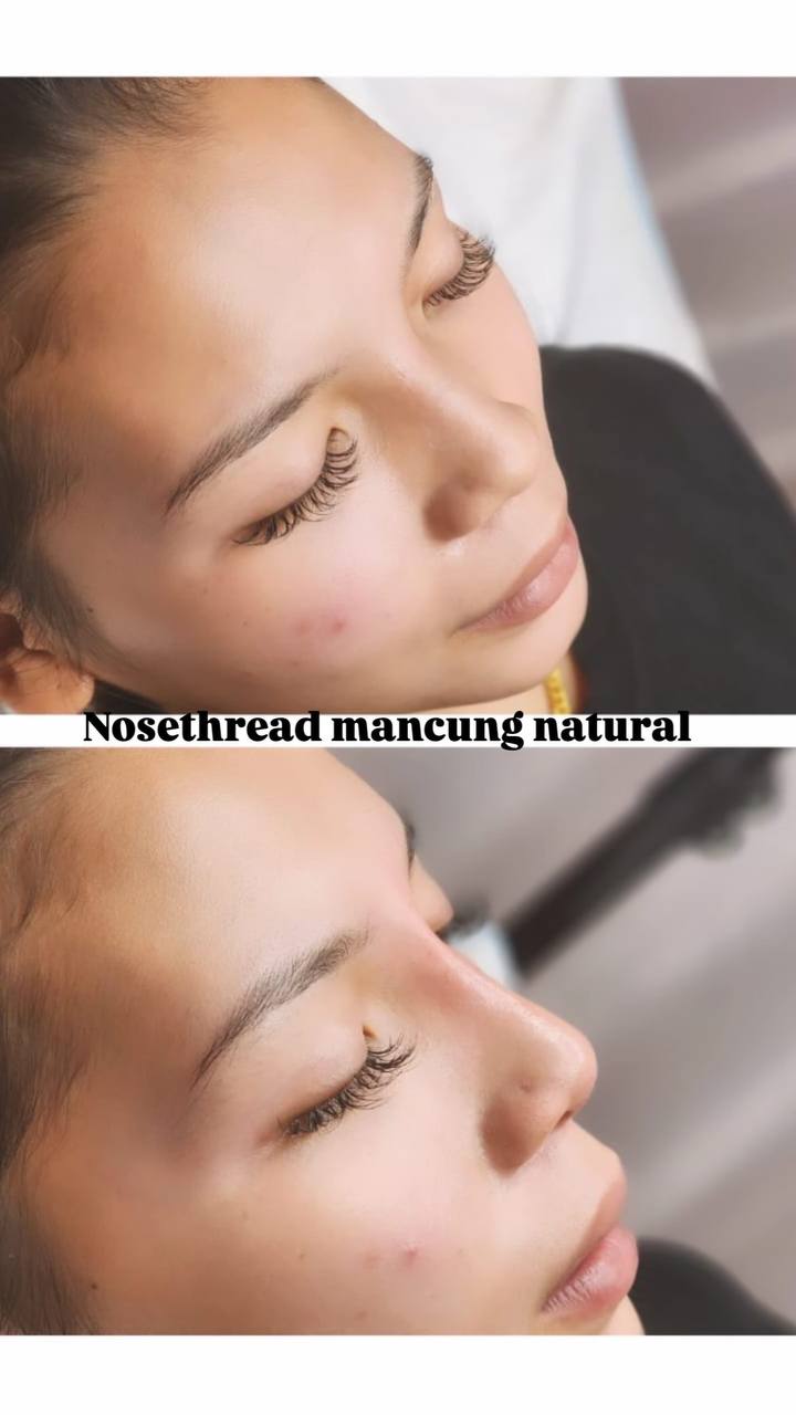 Botox & Fillers Treatment