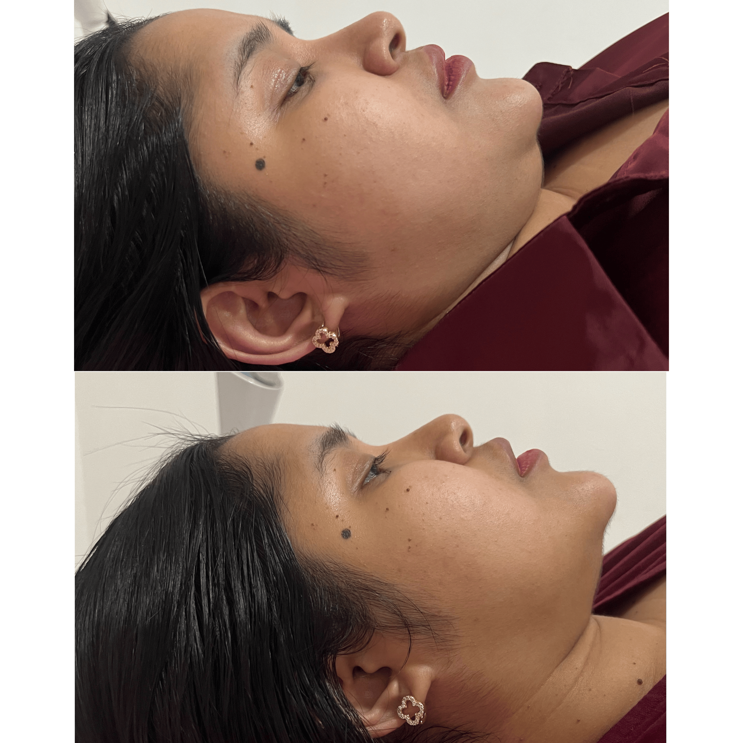 V-Shape Treatment Before & After